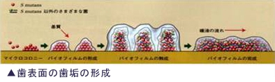 歯垢