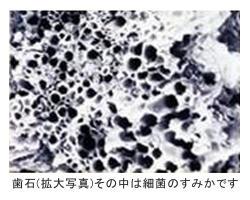 歯石