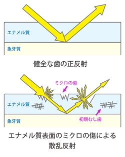 エナメル質へのダメージ
