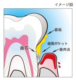 歯周病