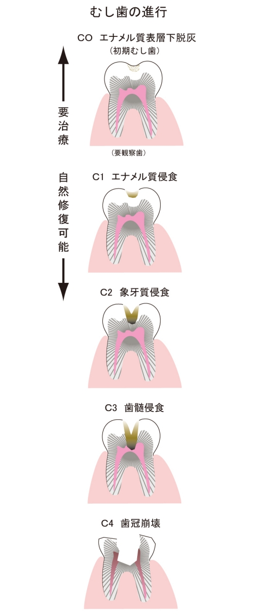 むし歯の進行