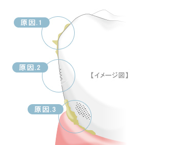 歯のエナメル小柱
